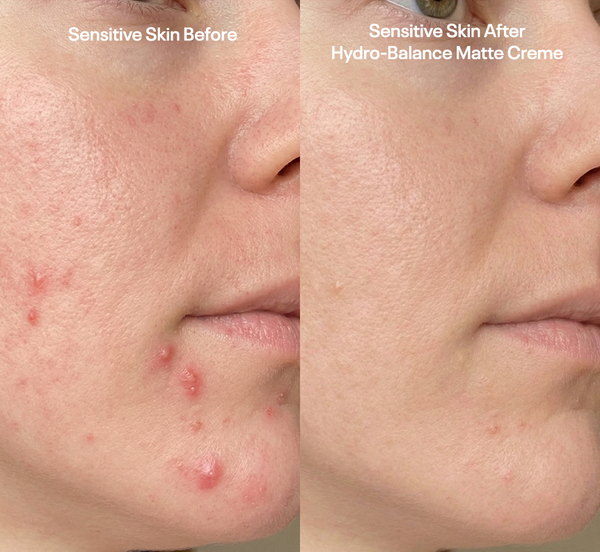Sensitive skin care
